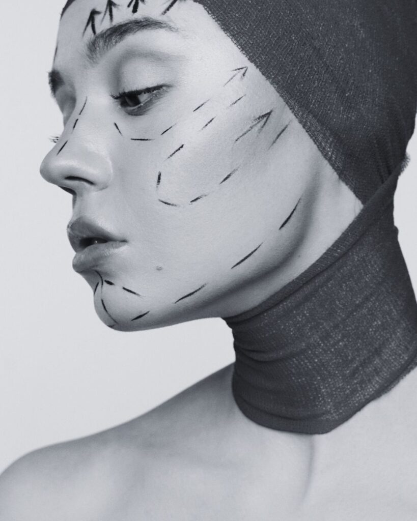 Black and white close-up profile of a woman with cosmetic surgery planning markings on her face and a compression wrap around her head and neck, illustrating facial contouring and regenerative aesthetic treatments.